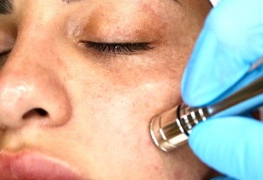 Microdermabrasion 