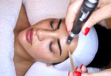 Microneedling 